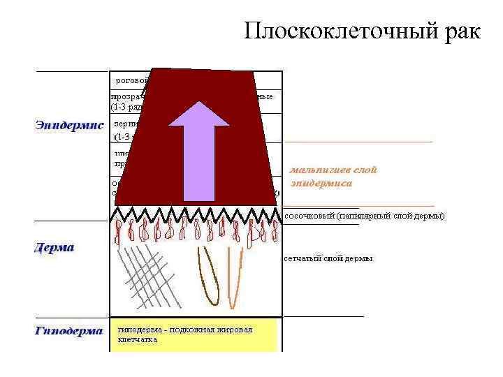 Плоскоклеточный рак 