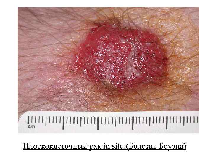 Плоскоклеточный рак in situ (Болезнь Боуэна) 