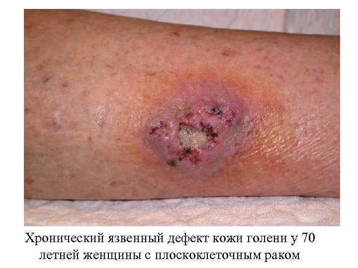 Хронический язвенный дефект кожи голени у 70 летней женщины с плоскоклеточным раком 