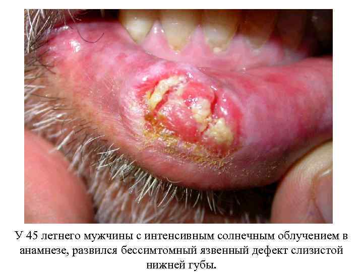 У 45 летнего мужчины с интенсивным солнечным облучением в анамнезе, развился бессимтомный язвенный дефект