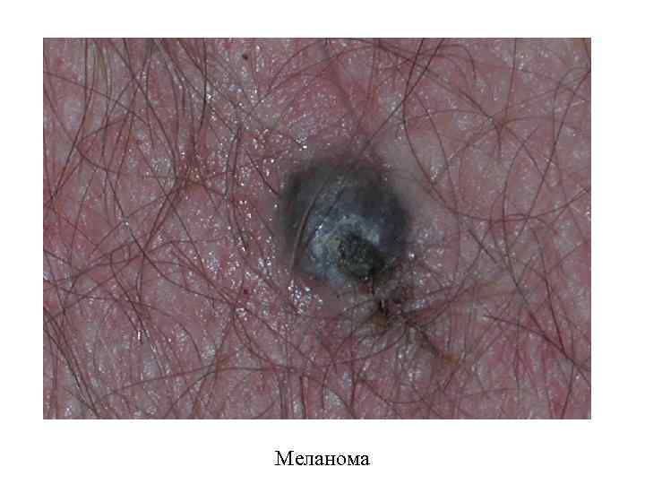 Меланома 