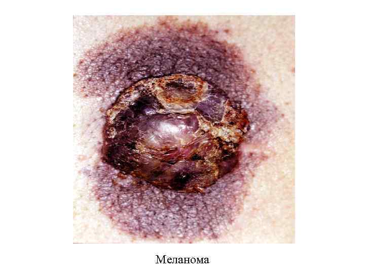 Меланома 