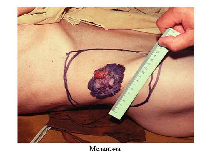 Меланома 