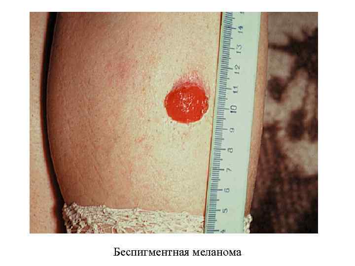 Беспигментная меланома 