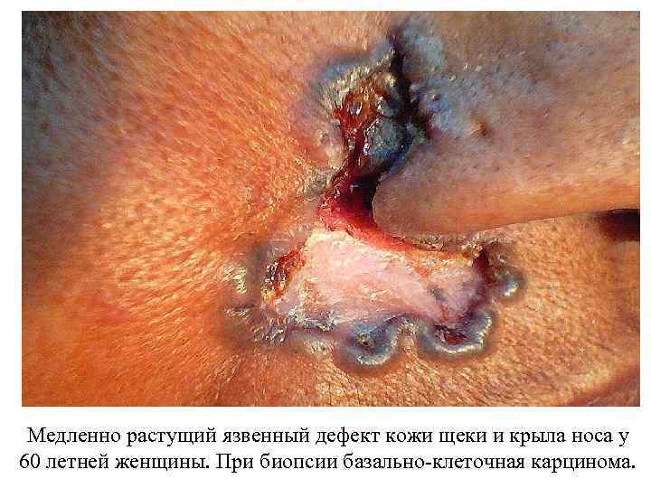 Медленно растущий язвенный дефект кожи щеки и крыла носа у 60 летней женщины. При