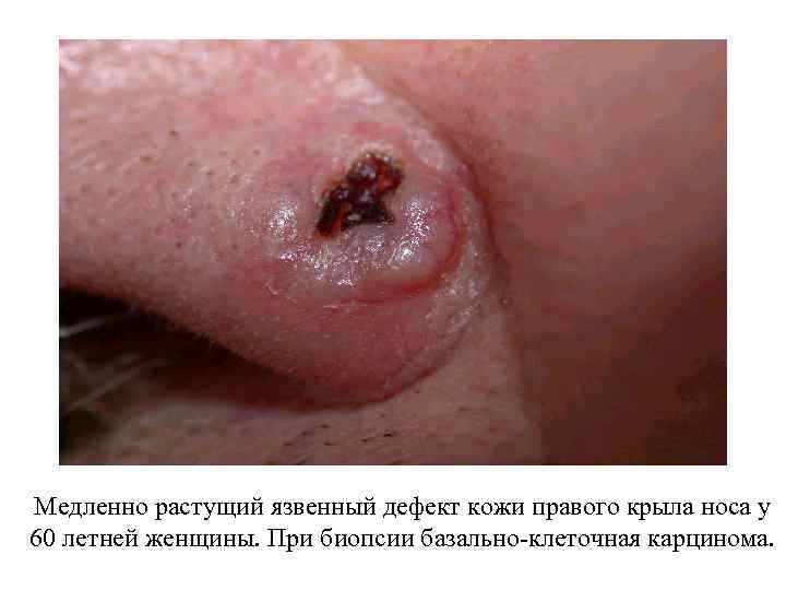 Медленно растущий язвенный дефект кожи правого крыла носа у 60 летней женщины. При биопсии