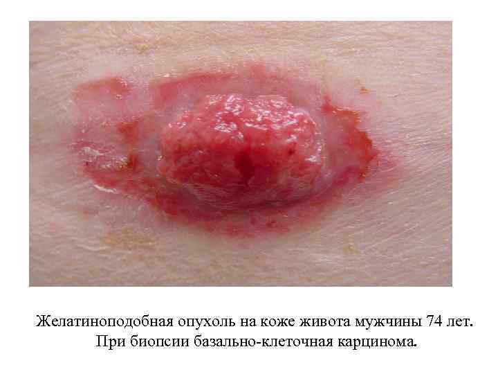 Желатиноподобная опухоль на коже живота мужчины 74 лет. При биопсии базально-клеточная карцинома. 
