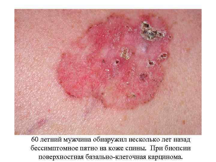 60 летний мужчина обнаружил несколько лет назад бессимптомное пятно на коже спины. При биопсии