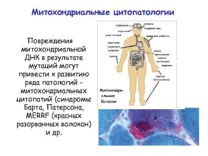 Митохондриальные цитопатологии Повреждения митохондриальной ДНК в результате мутаций могут привести к развитию ряда патологий
