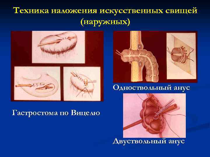 Техника наложения искусственных свищей (наружных) Одноствольный анус Гастростома по Вицелю Двуствольный анус 