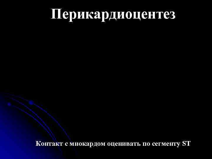 Перикардиоцентез Контакт с миокардом оценивать по сегменту ST 