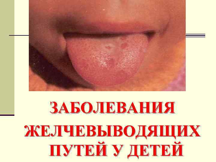 ЗАБОЛЕВАНИЯ ЖЕЛЧЕВЫВОДЯЩИХ ПУТЕЙ У ДЕТЕЙ 