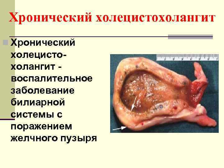 Хронический холецистохолангит n Хронический холецистохолангит воспалительное заболевание билиарной системы с поражением желчного пузыря 