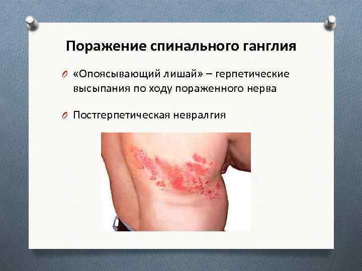 Поражение спинального ганглия O «Опоясывающий лишай» – герпетические высыпания по ходу пораженного нерва O