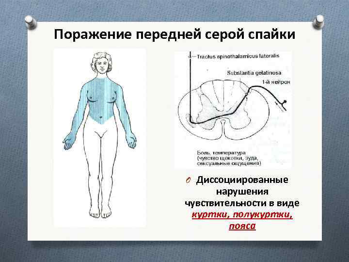 Поражение передней серой спайки O Диссоциированные нарушения чувствительности в виде куртки, полукуртки, пояса 