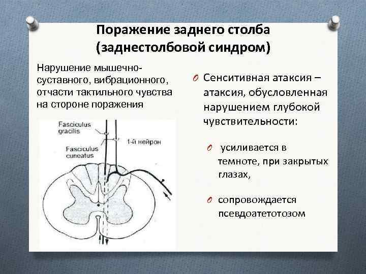 Поражение заднего столба (заднестолбовой синдром) Нарушение мышечносуставного, вибрационного, отчасти тактильного чувства на стороне поражения