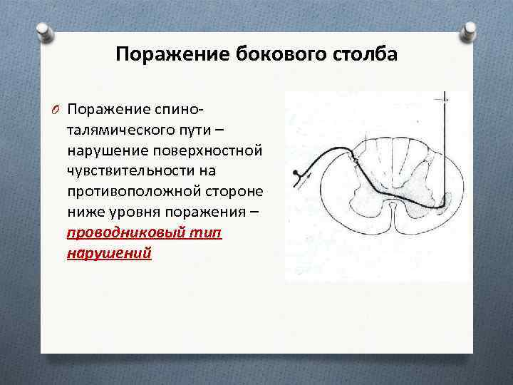 Боковой столб. Поражение бокового столба спинного мозга. Поражение поверхностной чувствительности. Спино-талямический путь. Синдром поражения бокового рога.