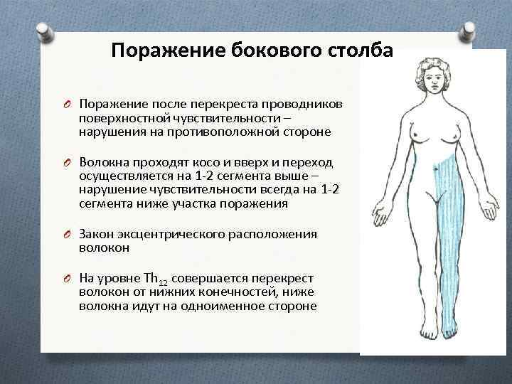 Поражение бокового столба O Поражение после перекреста проводников поверхностной чувствительности – нарушения на противоположной