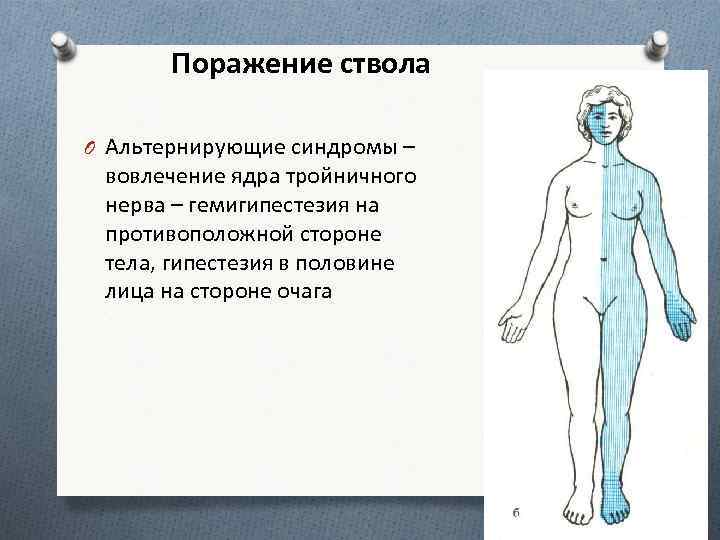 Поражение ствола O Альтернирующие синдромы – вовлечение ядра тройничного нерва – гемигипестезия на противоположной