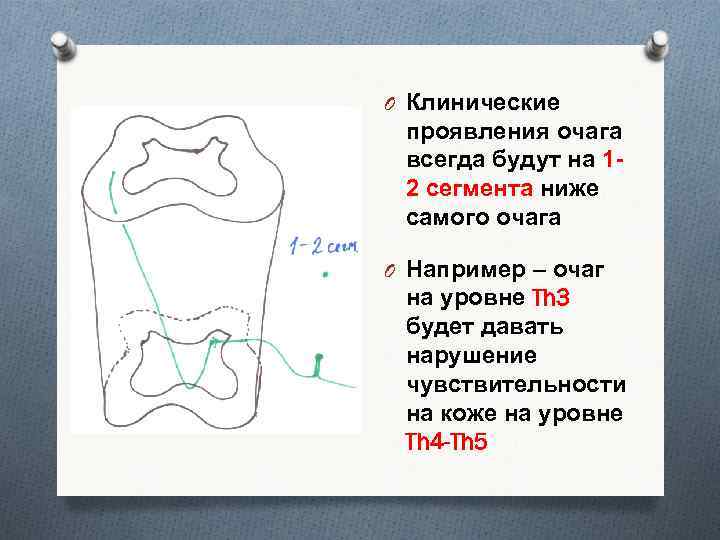 O Клинические проявления очага всегда будут на 12 сегмента ниже самого очага O Например