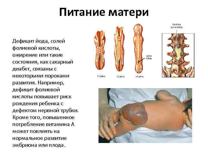 Питание матери Дефицит йода, солей фолиевой кислоты, ожирение или такие состояния, как сахарный диабет,