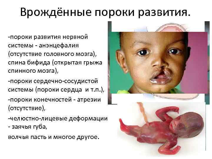Врождённые пороки развития. -пороки развития нервной системы - анэнцефалия (отсутствие головного мозга), спина бифида