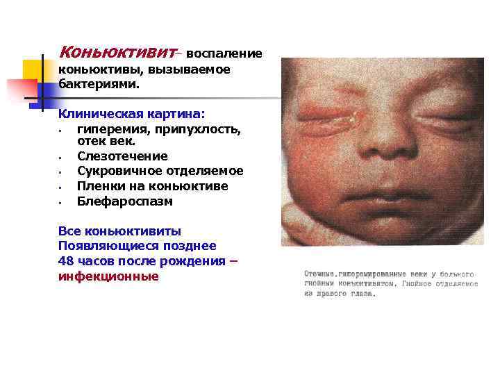 Коньюктивит– воспаление коньюктивы, вызываемое бактериями. Клиническая картина: § гиперемия, припухлость, отек век. § Слезотечение
