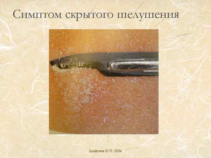 Симптом скрытого шелушения Smirnova O. V. 2006 