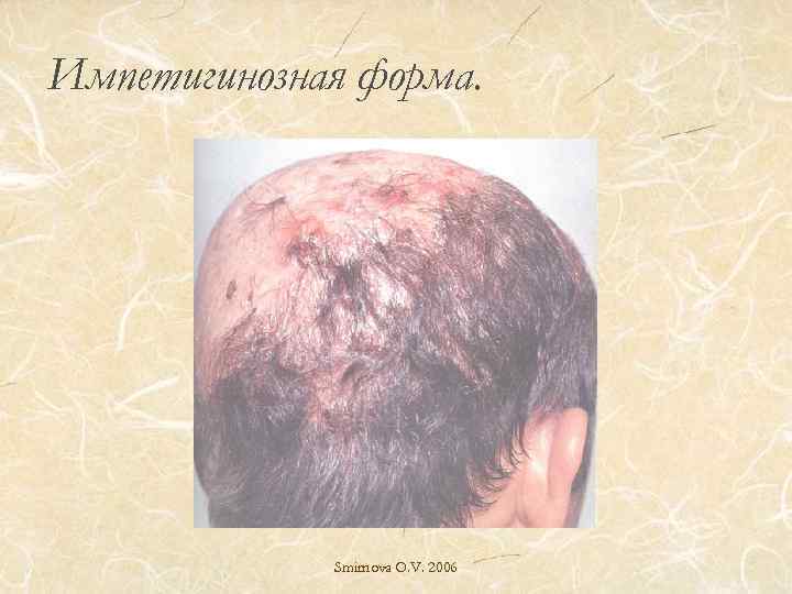 Импетигинозная форма. Smirnova O. V. 2006 