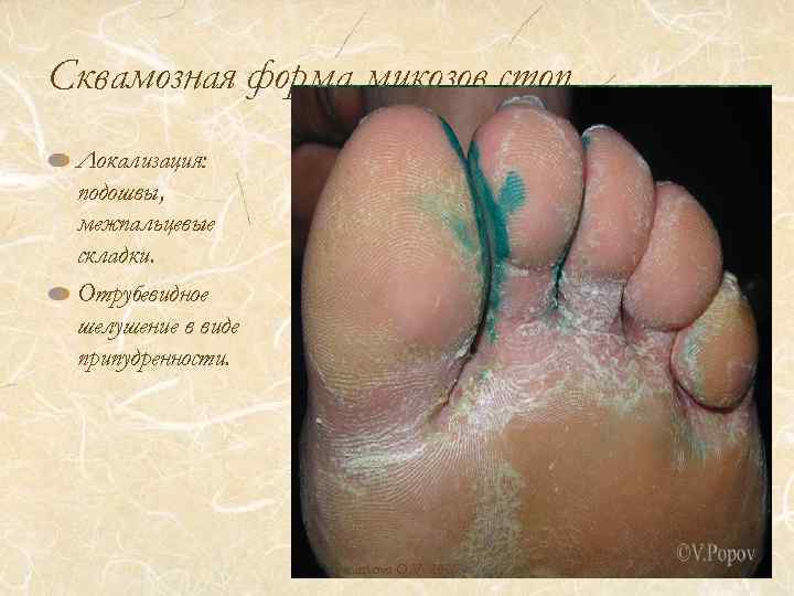 Сквамозная форма микозов стоп. Локализация: подошвы, межпальцевые складки. Отрубевидное шелушение в виде припудренности. Smirnova