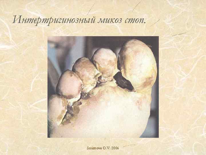 Интертригинозный микоз стоп. Smirnova O. V. 2006 