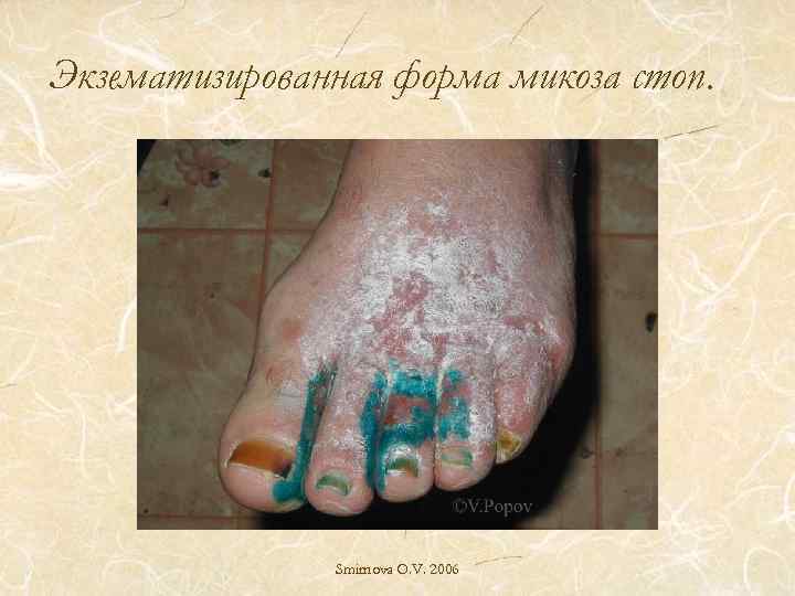 Экзематизированная форма микоза стоп. Smirnova O. V. 2006 