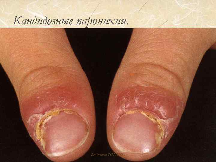 Кандидозные паронихии. Smirnova O. V. 2006 