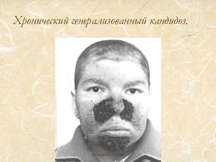Хронический генерализованный кандидоз. Smirnova O. V. 2006 