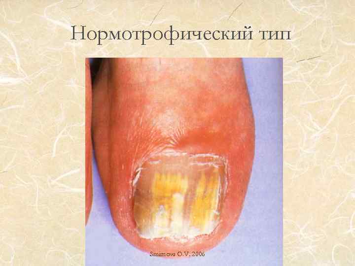 Нормотрофический тип Smirnova O. V. 2006 