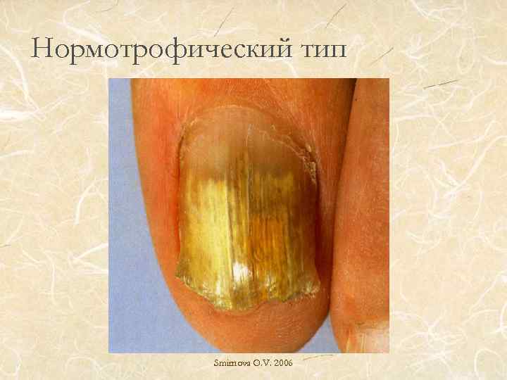 Нормотрофический тип Smirnova O. V. 2006 