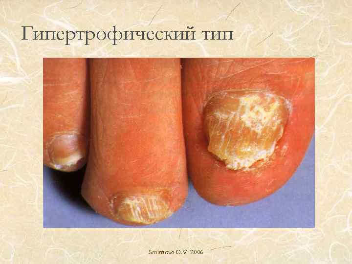 Гипертрофический тип Smirnova O. V. 2006 