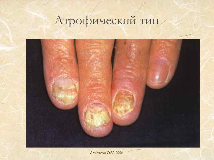 Атрофический тип Smirnova O. V. 2006 