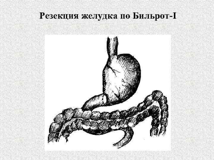 Резекция желудка по Бильрот-I 