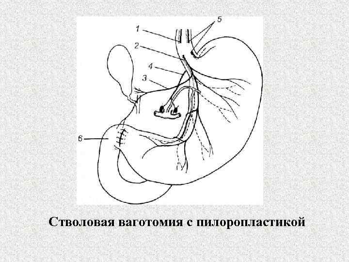 Стволовая ваготомия с пилоропластикой 