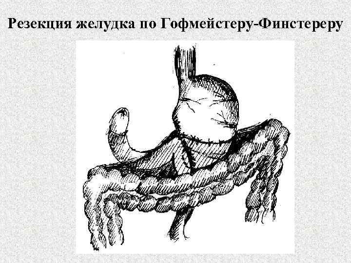 Резекция желудка по Гофмейстеру-Финстереру 