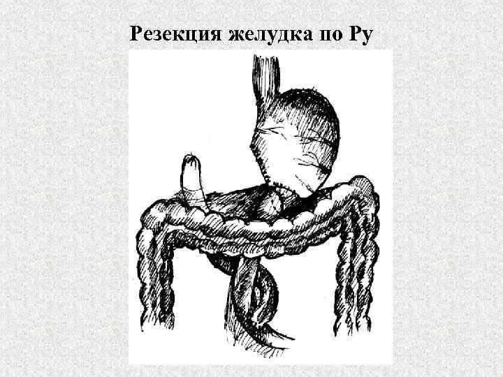 Резекция желудка по Ру 