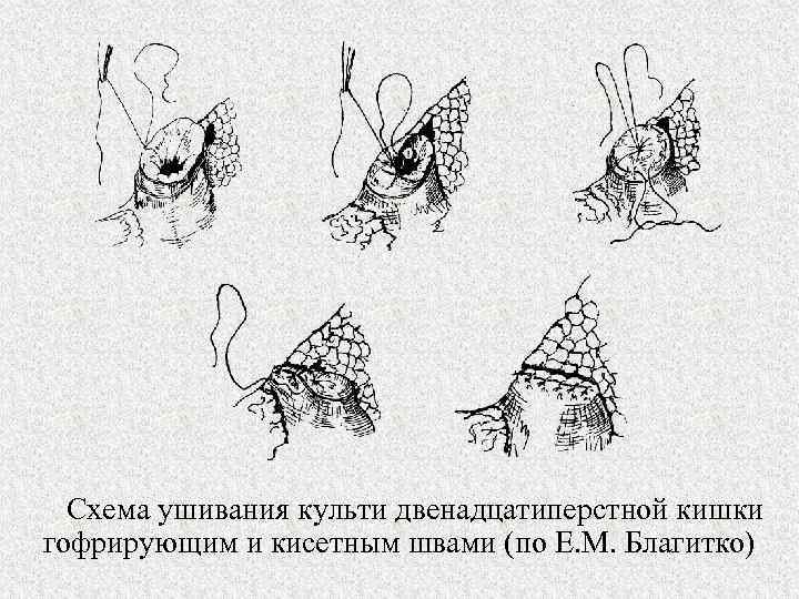 Схема ушивания культи двенадцатиперстной кишки гофрирующим и кисетным швами (по Е. М. Благитко) 
