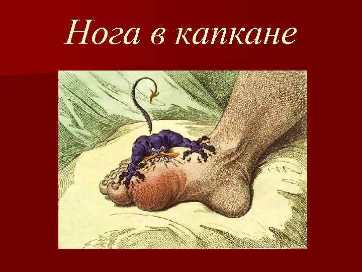 Нога в капкане 