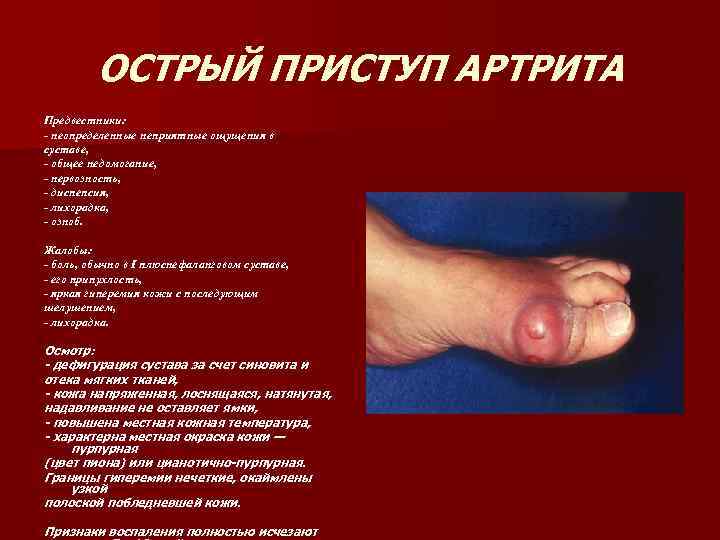 ОСТРЫЙ ПРИСТУП АРТРИТА Предвестники: - неопределенные неприятные ощущения в суставе, - общее недомогание, -
