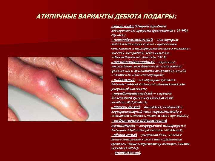 АТИПИЧНЫЕ ВАРИАНТЫ ДЕБЮТА ПОДАГРЫ: - типичный острый приступ подагрического артрита (развивается в 50 -80%