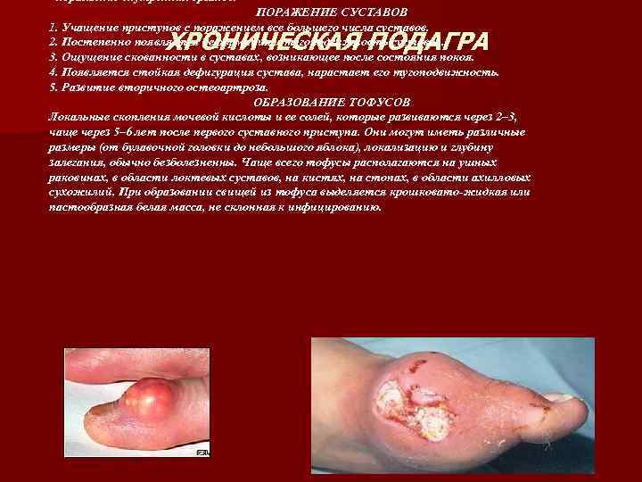 - поражение внутренних органов. ПОРАЖЕНИЕ СУСТАВОВ 1. Учащение приступов с поражением все большего числа