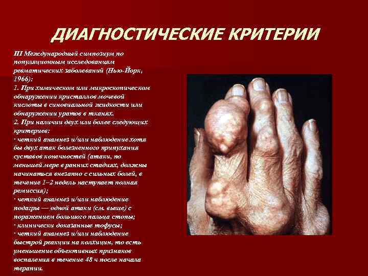 ДИАГНОСТИЧЕСКИЕ КРИТЕРИИ III Международный симпозиум по популяционным исследованиям ревматических заболеваний (Нью-Йорк, 1966): 1. При