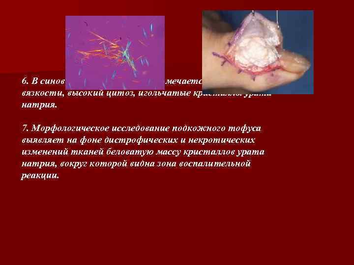 6. В синовиальной жидкости отмечается снижение вязкости, высокий цитоз, игольчатые кристаллы урата натрия. 7.
