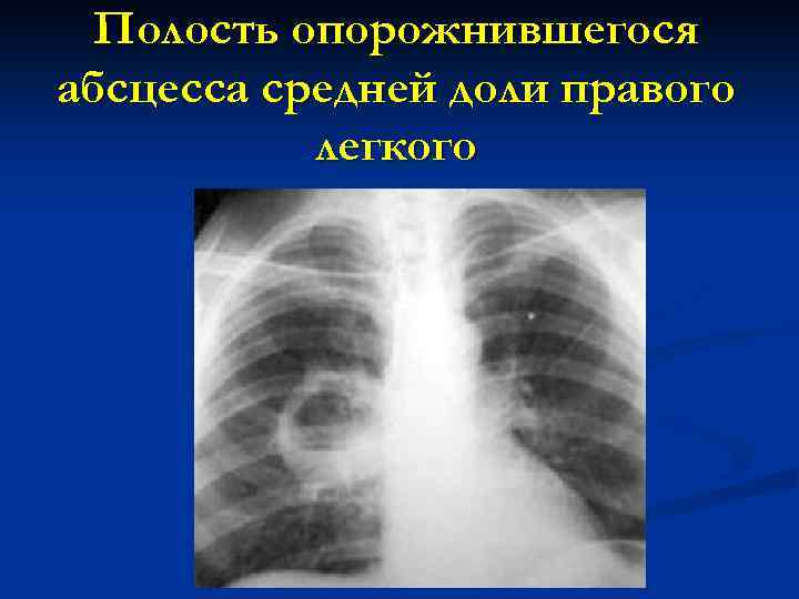 Полость опорожнившегося абсцесса средней доли правого легкого 